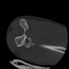 SPORK, NICO - 22.03.1976 - 02.08.2022 - CT obere Extremität - 17:59:38